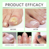 Onychomycosis Repair Essence Hand And Foot Nutrition