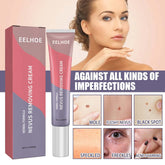 Skin Cleaning Removal Mole Wart Skin care lotion Hand And Foot
