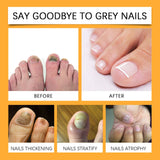 Hand And Foot Nail Fungus Cleansing Repairing, Softening Brightening Nutrient Care Solution