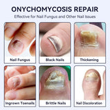 Hand And Foot Nail Thickening Bright Nail Gray Nail Antibacterial Care Solution