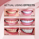 Removing Yellow Tooth Stains Dazzling White Beautiful Tooth Cleaning Oral Care